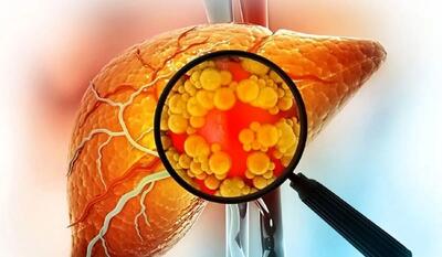  این بیماری کبد با شما شوخی ندارد جدی بگیرید