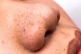  از شر  دانه‌های سرسیاه پوستی خلاص شوید!