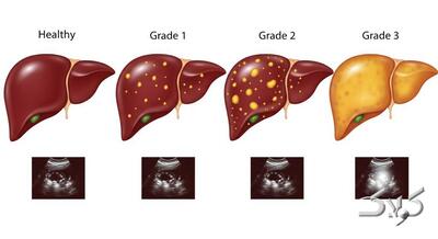  با گرید کبد چرب در آزمایش خون آشنا شوید! - مجله اینترنتی کولاک